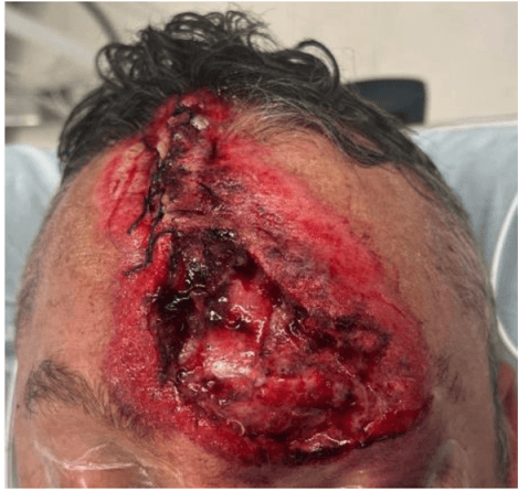Single-Stage Wound Repair Using Human Reticular ADM